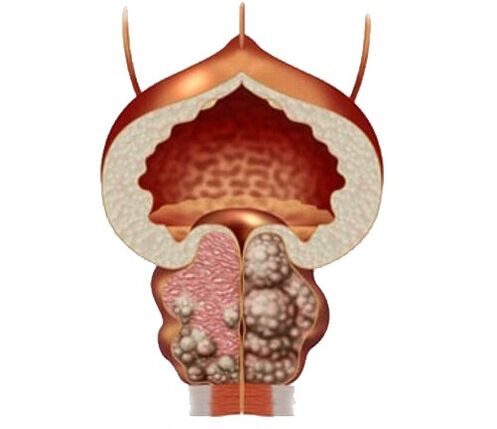 A prosztata adenoma és ödéma, valamint Urosaf kapszulákkal történő kezelés