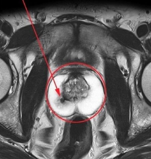 Prostatitis ultrahanghoz, mielőtt az urosafot szedi
